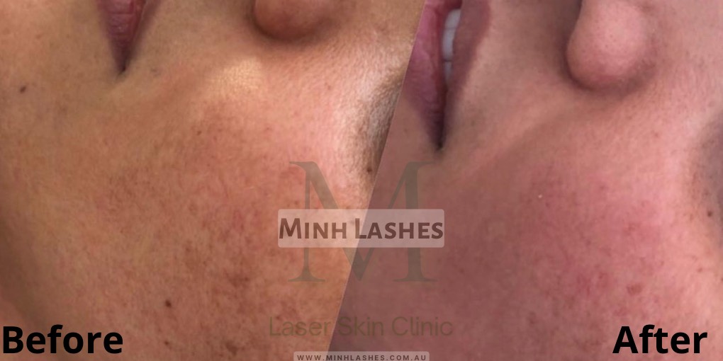 Minh Lashes - Eyelash Extensions - Hifu - Micro-needling - RF Micro-Needling - Tattoo Remove - Cosmetic Tattoo - Brow Tattoo - Brow Lamination - Laser Skin Clinic - Laser Hair Remove For Men & Women - Beauty Supplies