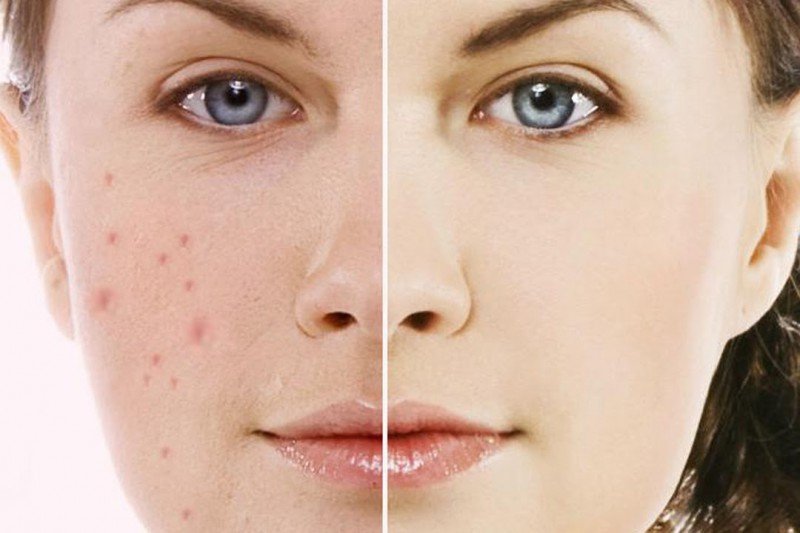 ACNE Scars RF Microneedling By Minh Lashes Beauty Clinic