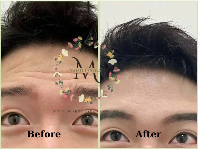 ANTI-WRINKLE INJECTIONS BY MINH LASHES BEAUTY CLINIC