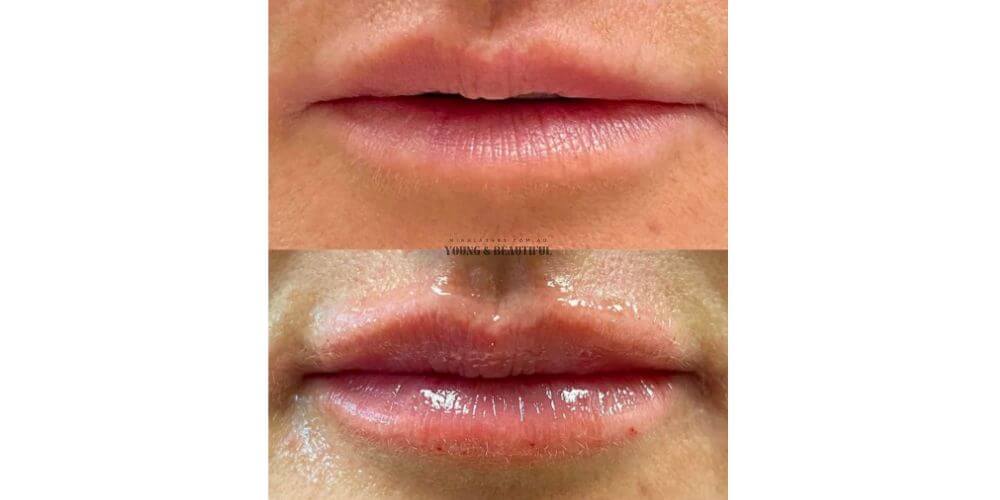 0.5 ml Lip Fillers by Minh Lashes Beauty Clinic in Yagoona, Bankstown and Sydney – natural lip enhancement for soft, balanced lips