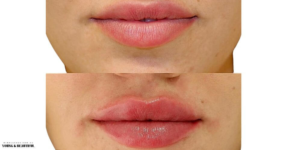 1ml Lip Filler Before and After