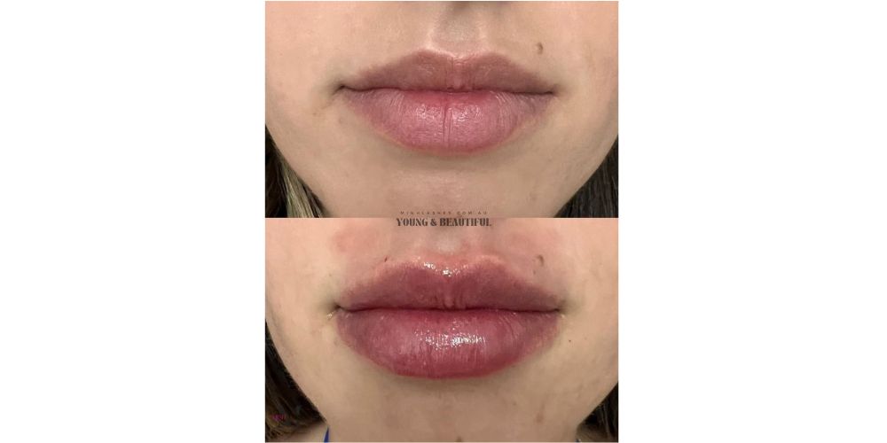 Natural 1ml lip filler by Minh Lashes Beauty Clinic in Yagoona, Bankstown, and Sydney — expert cosmetic injector creating soft, balanced, and enhanced lips.