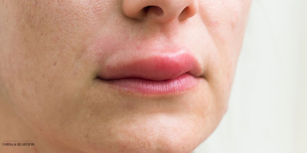 Close-up photo showing uneven, overfilled lips caused by bad lip filler, illustrating poor injection results and the need for professional correction at Minh Lashes Beauty Clinic in Sydney.