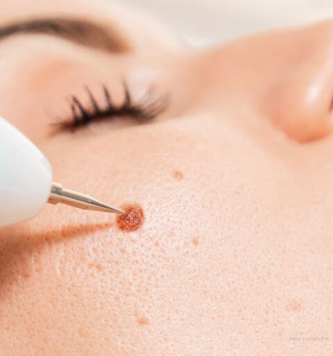 Moles and skin tags removal treatment at Minh Lashes Beauty Clinic, Sydney – Safe, non-invasive cosmetic procedures.