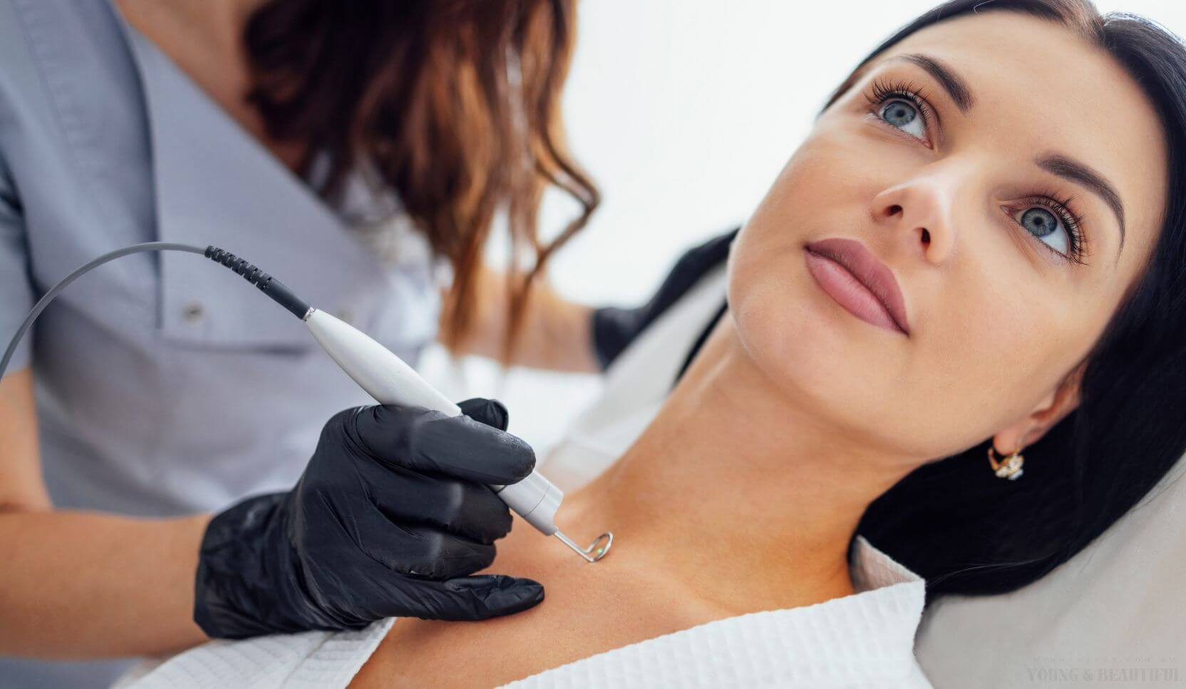 Expert moles and skin tags removal at Minh Lashes Beauty Clinic, Sydney – Safe, effective cosmetic skin treatments.