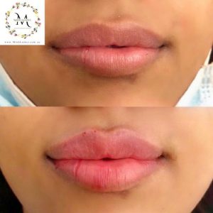 Natural-looking lip filler results with subtle volume enhancement at Minh Lashes Beauty Clinic in Yagoona, Sydney.