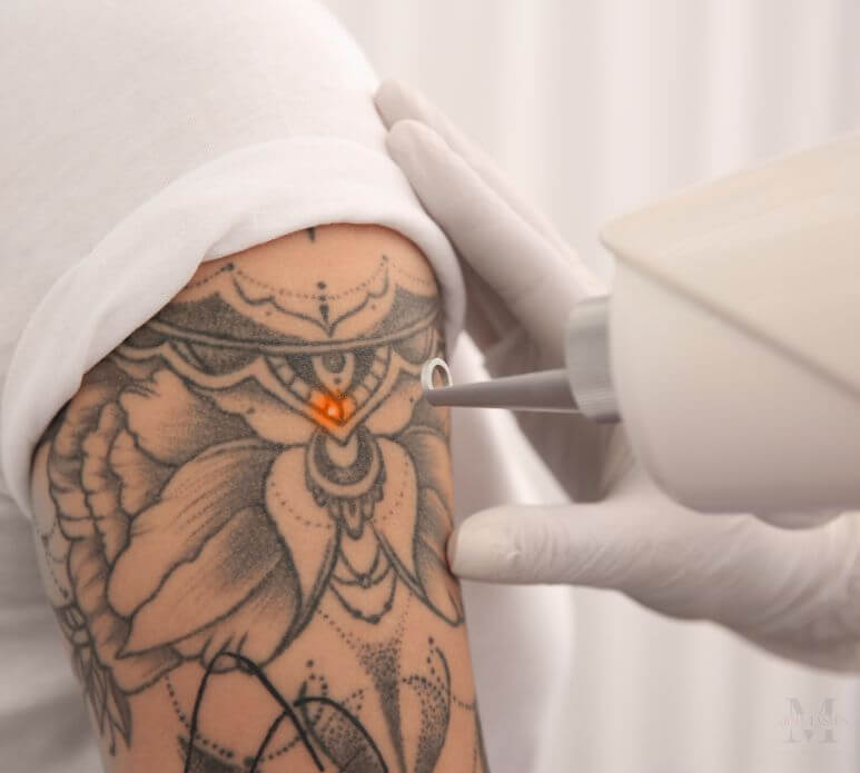 Laser tattoo removal treatment at Minh Lashes Beauty Clinic for safe and effective results.